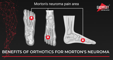 Orthotics for Morton's Neuroma